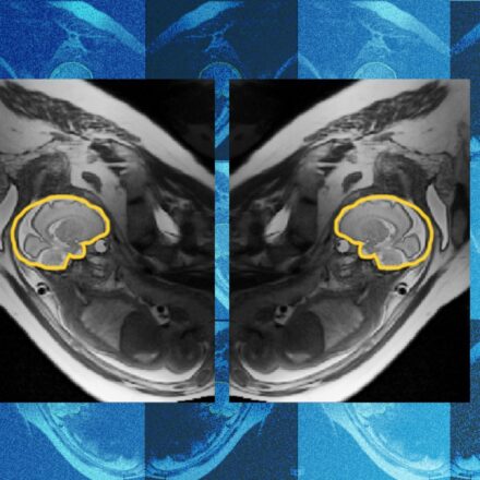 Why teaching AI about symmetry could make prenatal diagnosis more reliable | MIT News