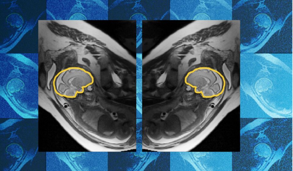 Why teaching AI about symmetry could make prenatal diagnosis more reliable | MIT News